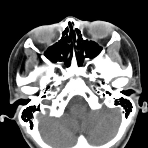 File:Ameloblastoma (Radiopaedia 26645-26793 Axial C+ delayed 36).jpg