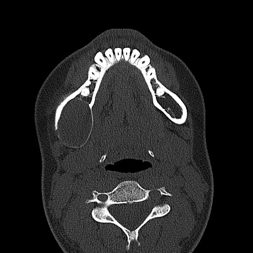 File:Ameloblastoma (Radiopaedia 26645-26793 E 24).jpg