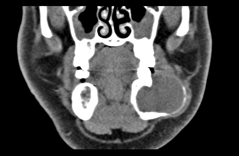 Ameloblastoma (Radiopaedia 33677-34806 Coronal non-contrast 23).png