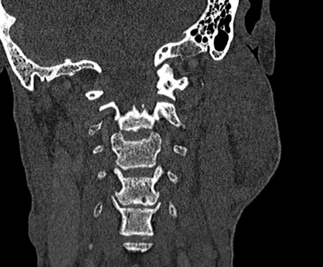 Ameloblastoma (Radiopaedia 51921-57766 Coronal bone window 241).jpg