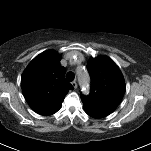 File:Amiodarone-induced pulmonary fibrosis (Radiopaedia 82355-96460 Axial non-contrast 19).jpg