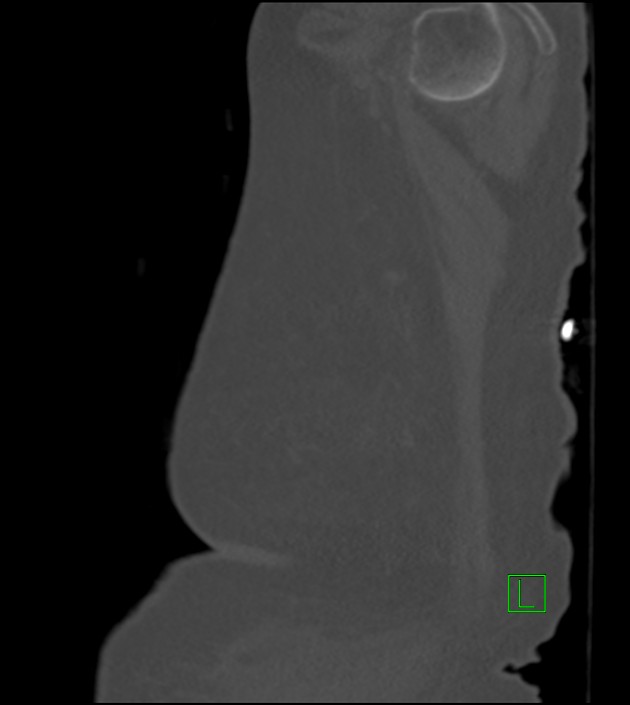 Amiodarone deposition in the liver (Radiopaedia 77587-89780 Sagittal bone window 9).jpg