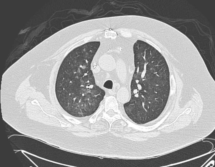 File:Amiodarone lung (Radiopaedia 62514-70769 Axial lung window 30).jpg