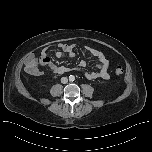 Ampullary adenocarcinoma (Radiopaedia 59373-66737 A 99).jpg