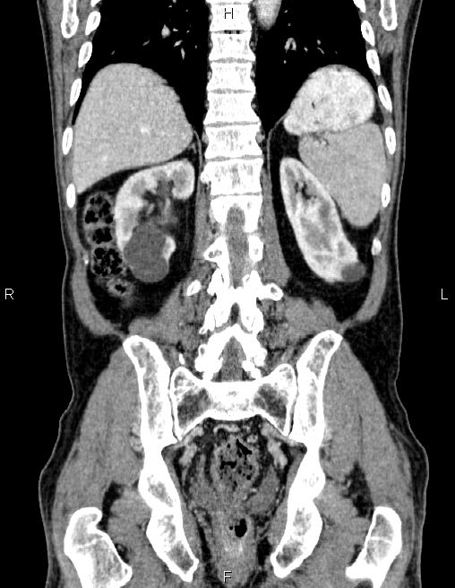 Ampullary adenocarcinoma (Radiopaedia 86093-102032 C 50).jpg
