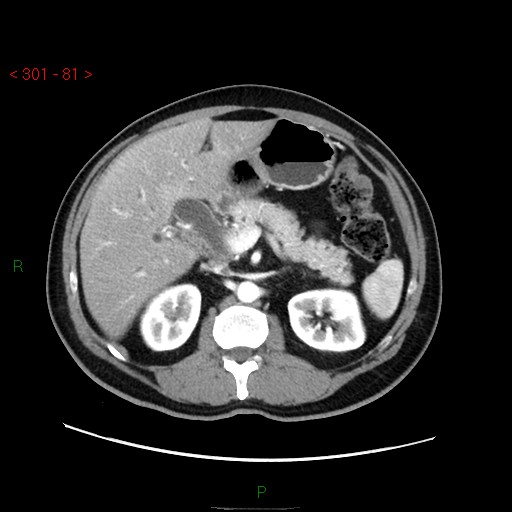 File:Ampullary carcinoma (Radiopaedia 56396-63056 B 27).jpg