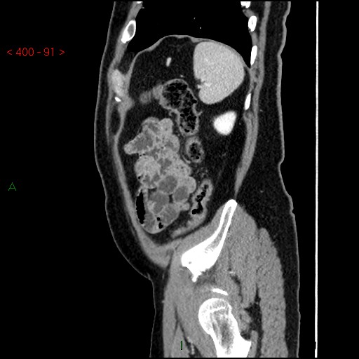 Ampullary carcinoma (Radiopaedia 56396-63056 D 90).jpg