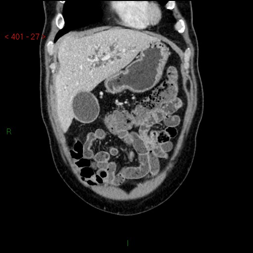 Ampullary carcinoma (Radiopaedia 56396-63056 E 26).jpg
