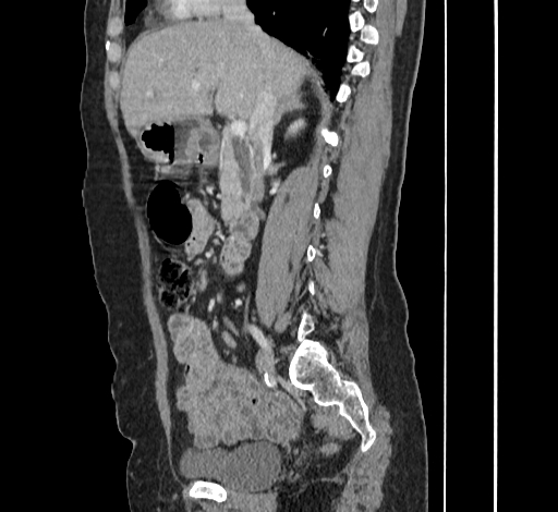 File:Ampullary tumor (Radiopaedia 60333-67998 C 23).jpg