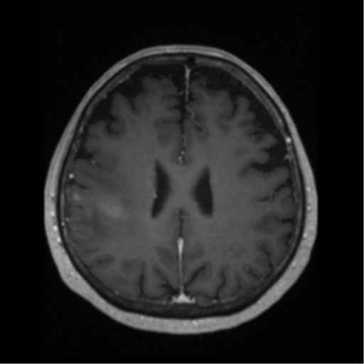 File:Anaplastic astrocytoma IDH wild-type (pseudoprogression) (Radiopaedia 42209-45276 Axial T1 C+ 97).png