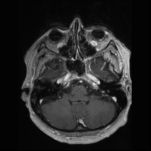 File:Anaplastic astrocytoma IDH wild-type (pseudoprogression) (Radiopaedia 42209-45277 Axial T1 C+ 24).png