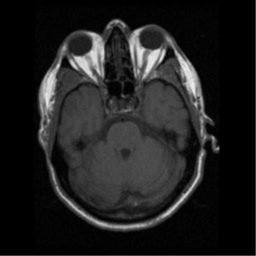 File:Anaplastic meningioma with recurrence (Radiopaedia 34452-35783 Axial T1 6).png