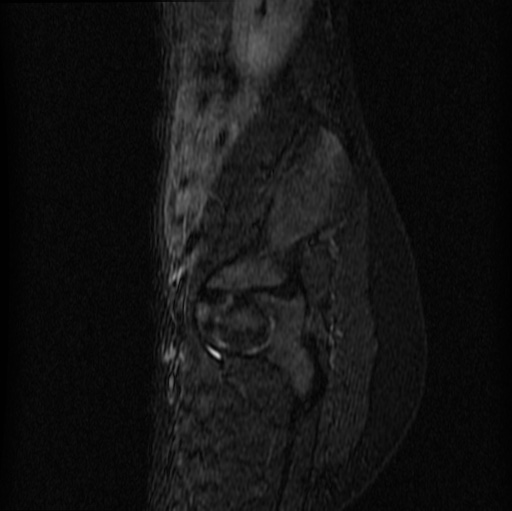 File:Aneurysmal bone cyst - sacrum (Radiopaedia 65190-74196 Sagittal STIR 8).jpg