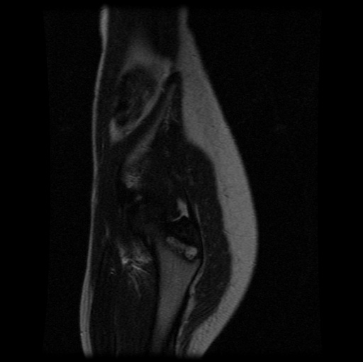 File:Aneurysmal bone cyst - sacrum (Radiopaedia 65190-74196 Sagittal T2 2).jpg