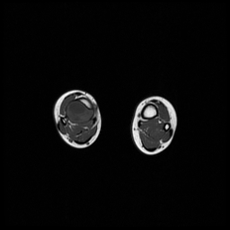 File:Aneurysmal bone cyst - tibia (Radiopaedia 22343-22367 Axial T1 11).jpg