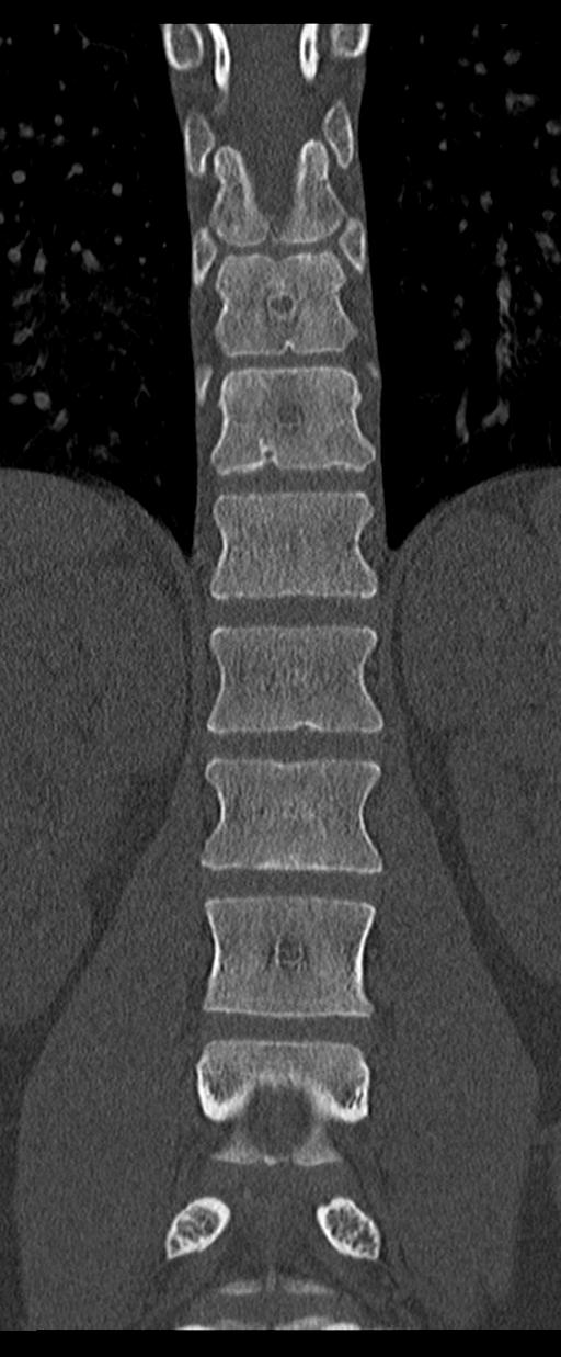 Aneurysmal bone cyst T11 (Radiopaedia 29294-29721 Coronal bone window 32).jpg