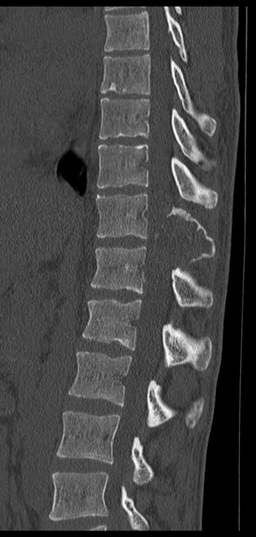 Aneurysmal bone cyst T11 (Radiopaedia 29294-29721 Sagittal bone window 38).jpg