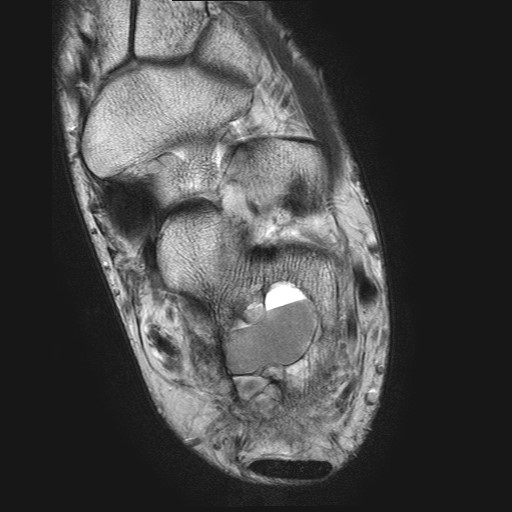 File:Aneurysmal bone cyst of the calcaneus (Radiopaedia 60669-68420 Axial T2 14).jpg