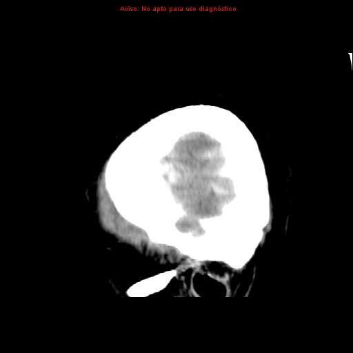 File:Aneurysmal subarachnoid hemorrhage (Radiopaedia 24740-24997 non-contrast 49).jpg