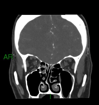 Aneurysmal subarachnoid hemorrhage with intra-axial extension (Radiopaedia 84371-99732 C 75).jpg