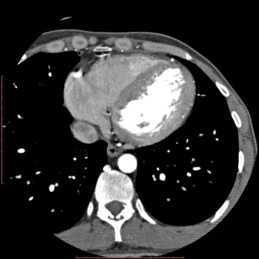 Anomalous left coronary artery from the pulmonary artery (ALCAPA) (Radiopaedia 70148-80181 A 274).jpg