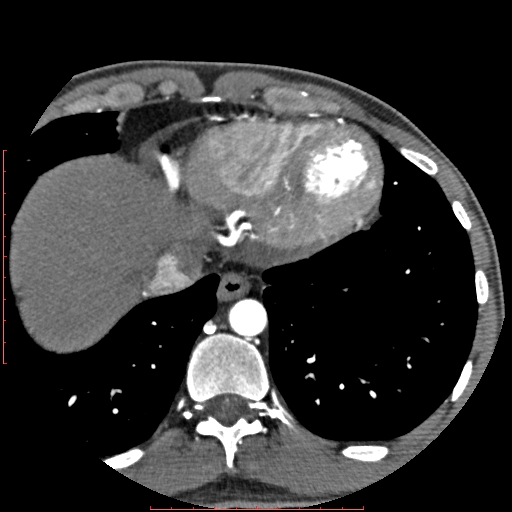 Anomalous left coronary artery from the pulmonary artery (ALCAPA) (Radiopaedia 70148-80181 A 336).jpg