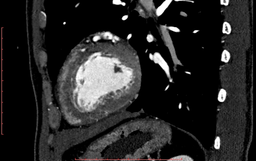 File:Anomalous left coronary artery from the pulmonary artery (ALCAPA) (Radiopaedia 70148-80181 C 193).jpg