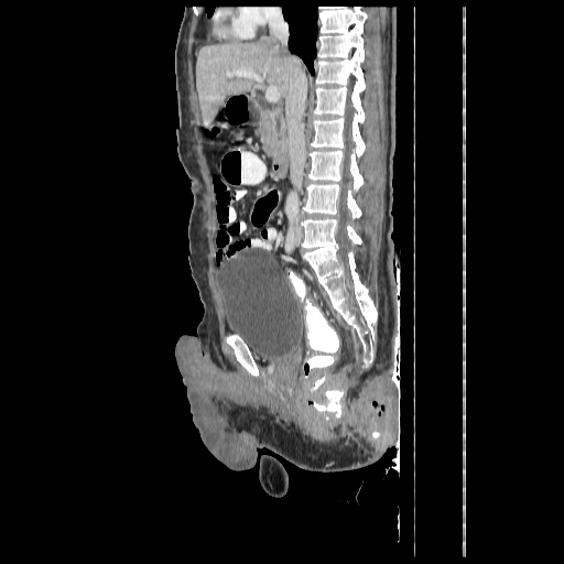 Anorectal carcinoma (Radiopaedia 44413-48064 C 49).jpg