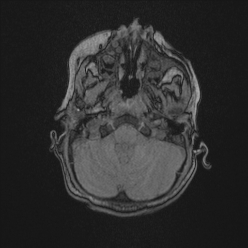 Anoxic brain injury (Radiopaedia 79165-92139 Axial MRA 38).jpg