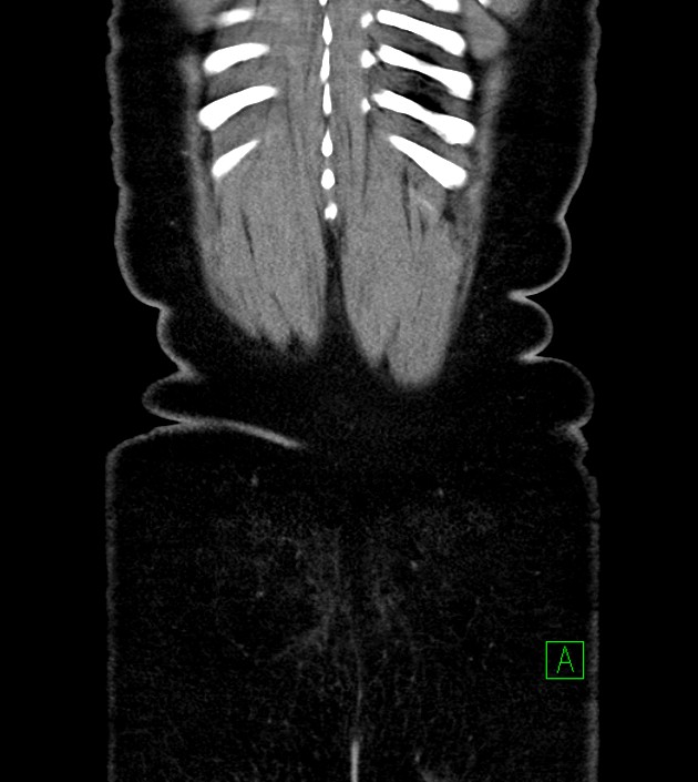 Anterior abdominal wall CSF pseudocyst (CSFoma) (Radiopaedia 79453-92571 B 52).jpg
