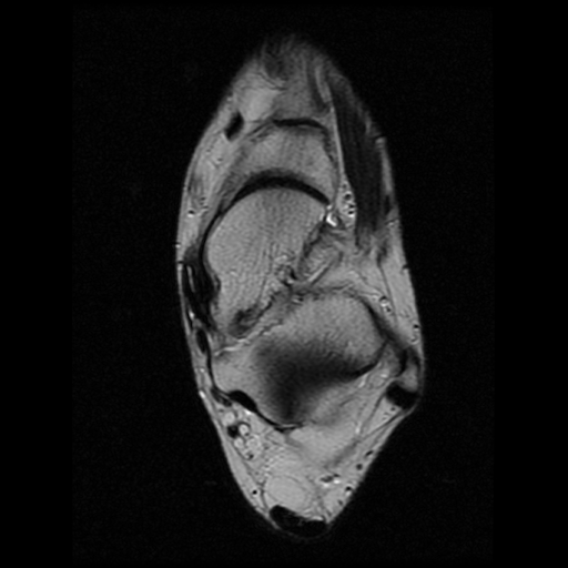 File:Anterior calcaneal process fracture (Radiopaedia 74654-85611 Axial T2 13).jpg