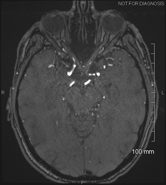 Anterior cerebral artery aneurysm (Radiopaedia 80683-94127 Axial MRA 96).jpg
