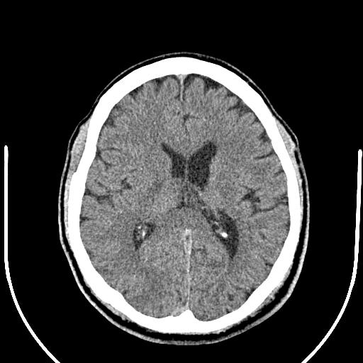 Anterior choroidal artery infarct (Radiopaedia 55106-61480 Axial non-contrast 33).jpg