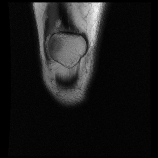 File:Anterior cruciate ligament avulsion fracture (Radiopaedia 58939-66193 Coronal T1 2).jpg