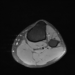 File:Anterior cruciate ligament full thickness tear (Radiopaedia 66268-75467 Axial PD fat sat 29).jpg