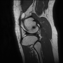 Anterior cruciate ligament rupture and posteromedial corner injury (Radiopaedia 67338-76723 Sagittal PD 138).jpg