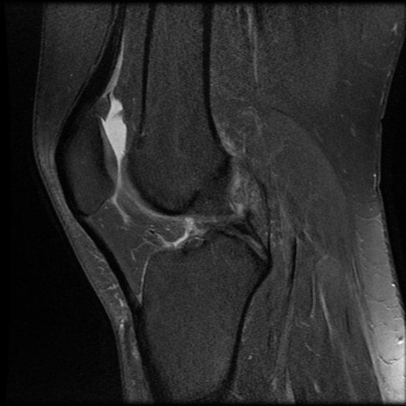 File:Anterior cruciate ligament tear, Wrisberg rip and bucket-handle tear of medial meniscus (Radiopaedia 75872-87266 Sagittal PD fat sat 12).jpg