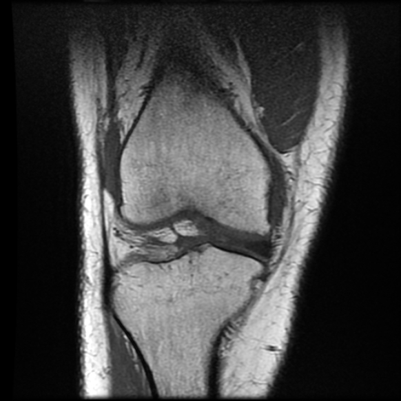 File:Anterior cruciate ligament tear with posteromedial corner injury, bucket-handle meniscal tear and chondral delamination (Radiopaedia 75501-86744 Coronal T1 9).jpg
