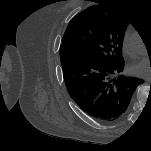 File:Anterior glenohumeral dislocation with Hill-Sachs lesion (Radiopaedia 62877-71249 Axial bone window 108).jpg