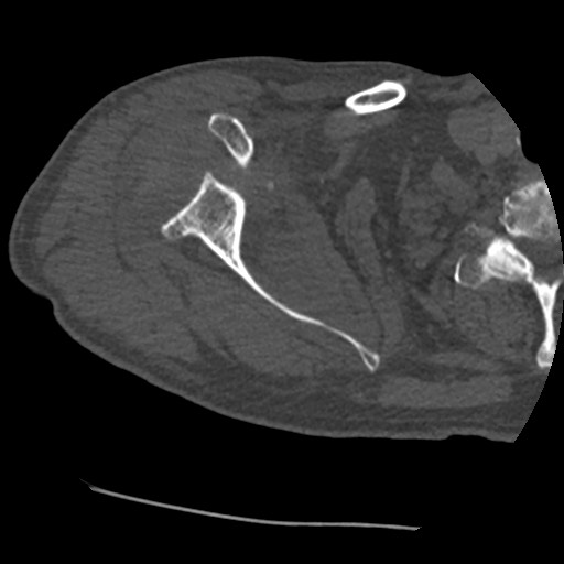 File:Anterior glenohumeral dislocation with Hill-Sachs lesion (Radiopaedia 62877-71249 Axial bone window 30).jpg