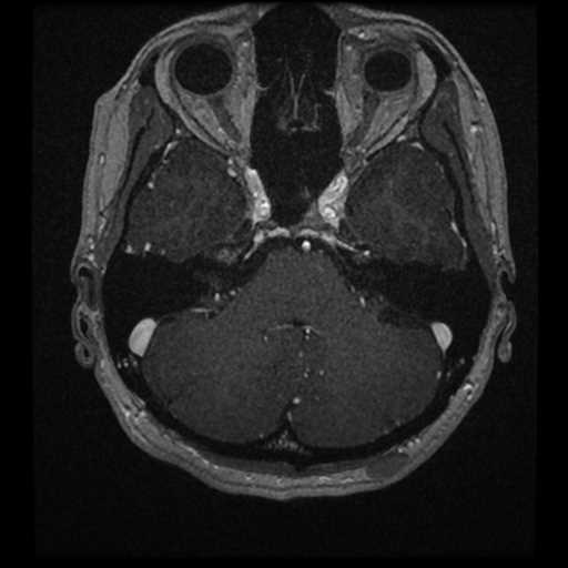 Anterior inferior cerebellar artery vascular loop - type II (Radiopaedia 70991-81209 Axial T1 C+ 44).jpg