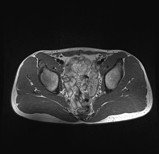 File:Anterior inferior iliac spine avulsion fracture (Radiopaedia 81312-95000 Axial T1 23).jpg
