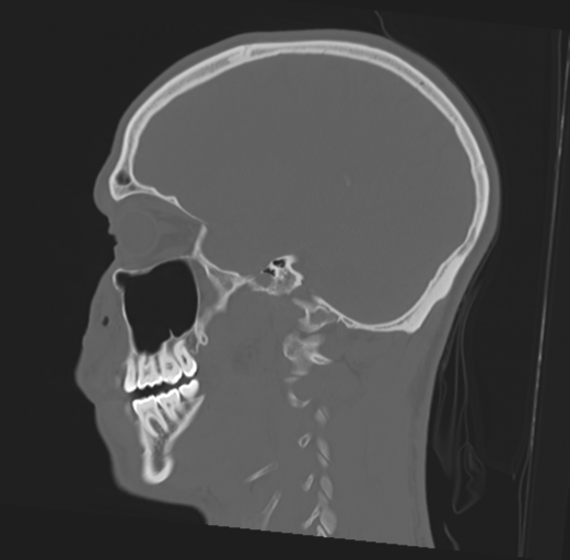 Anterior nasal spine fracture (Radiopaedia 46138-50494 Sagittal bone window 37).png