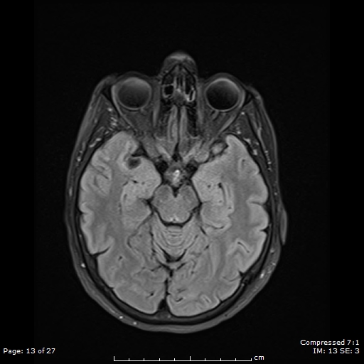 File:Anterior temporal lobe perivascular space (Radiopaedia 88283-104914 Axial FLAIR 13).jpg