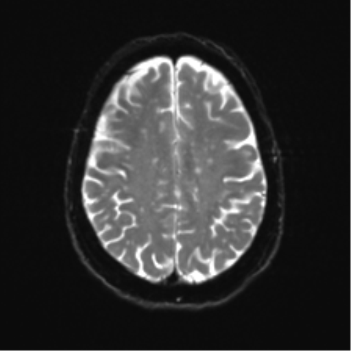 Anterior temporal pole cysts (Radiopaedia 46629-51102 Axial DWI 20).png