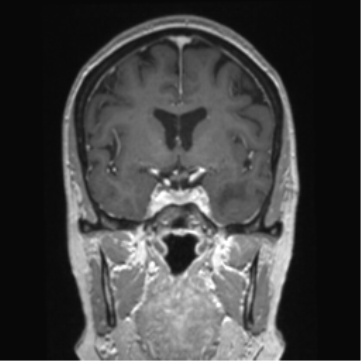 Anterior temporal pole cysts (Radiopaedia 46629-51102 Coronal T1 C+ 104).png