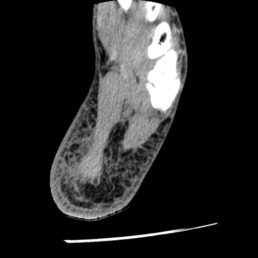 File:Anterior tibial artery false aneurysm (Radiopaedia 88984-105809 A 227).jpg