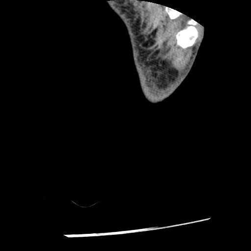 Anterior tibial artery false aneurysm (Radiopaedia 88984-105809 A 272).jpg