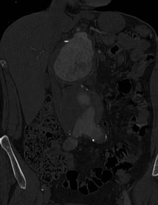 Anterior vertebral scalloping (abdominal aortic aneurysm) (Radiopaedia 66744-76067 Coronal bone window 10).jpg