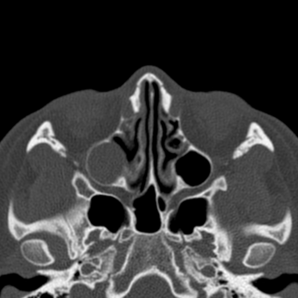 Antrochoanal polyp (Radiopaedia 33984-35202 Axial bone window 39).jpg